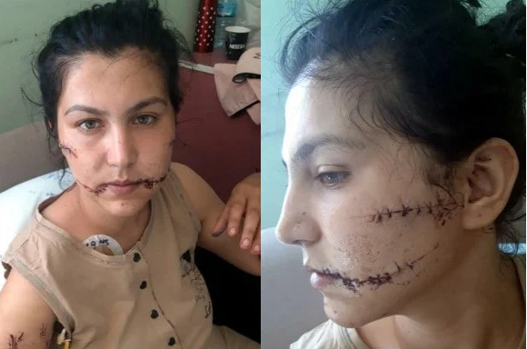 «Με χτυπούσε στο κεφάλι με μπουκάλι, σκέπασα το παιδί για να μην πάνε πάνω του γυαλιά»