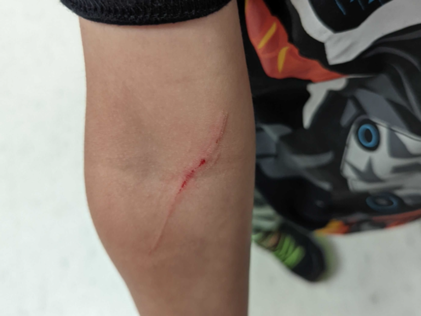 Πατέρας προειδοποιεί για τον τραυματισμό του γιου του | Infokids.gr