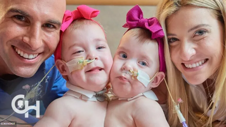 Σιαμαία δίδυμα ενωμένα στο διάφραγμα διαχωρίζονται