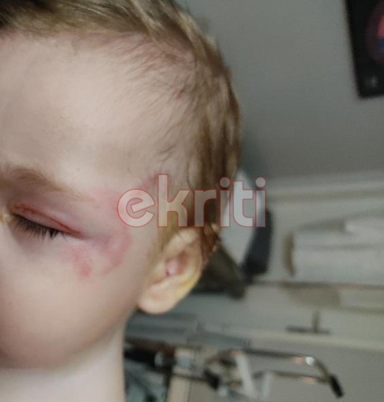 Στο νοσοκομείο το 8 μηνών αγοράκι που δέχθηκε επίθεση από λυκόσκυλο στην Κρήτη