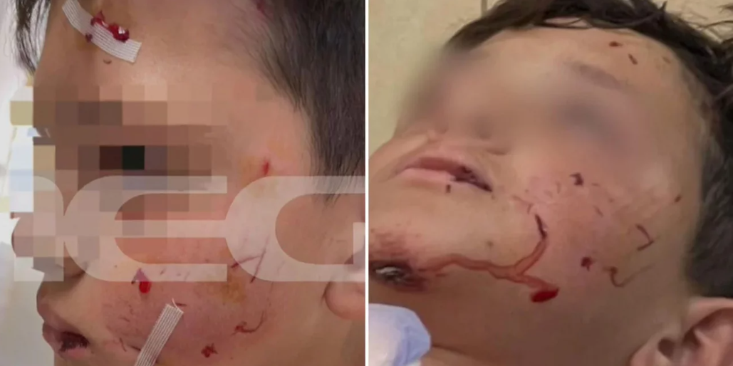 Λαγονήσι: Σκύλος επιτέθηκε σε μαθητή την ώρα που πήγαινε σχολείο - Με σοβαρά τραύματα το παιδί